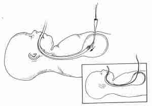 sondino-nasogastrico